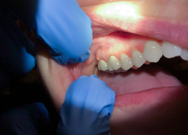 Best Dentist for Tooth Abscess  in Granite Hills, CA