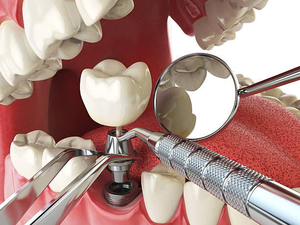 Best Knocked-Out Tooth Emergency  in Granite Hills, CA